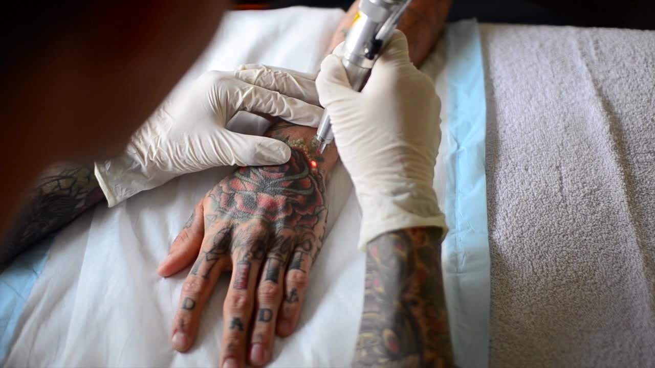 Laser tattoo removal procedure in progress