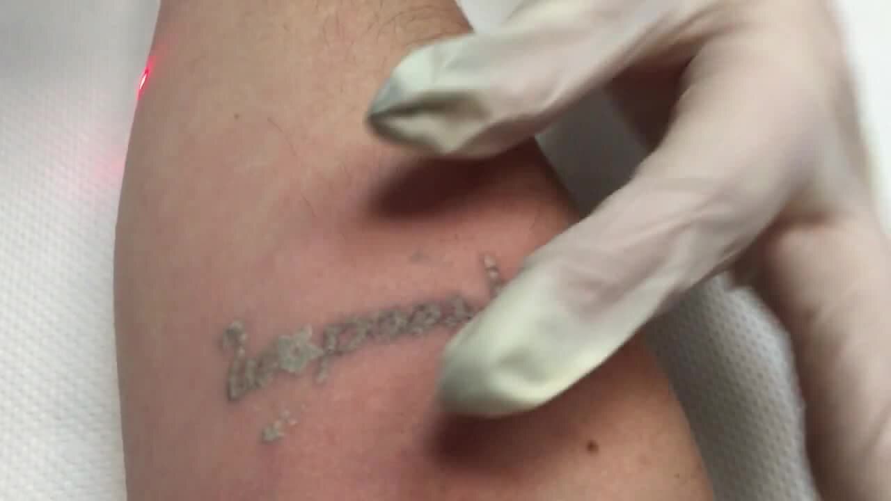 Pico laser tattoo removal procedure