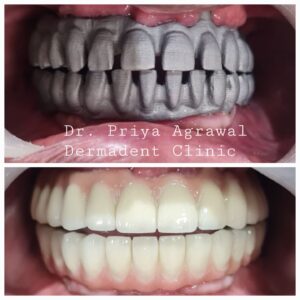 Digital Mockup and Dental Crowns