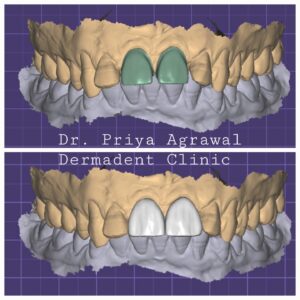 Digital Scans for dental crowns in Udaipur