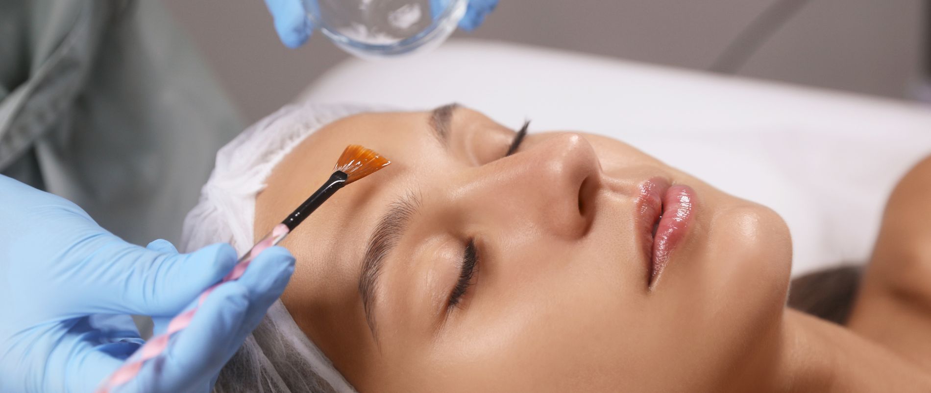 Chemical Peel Treatment