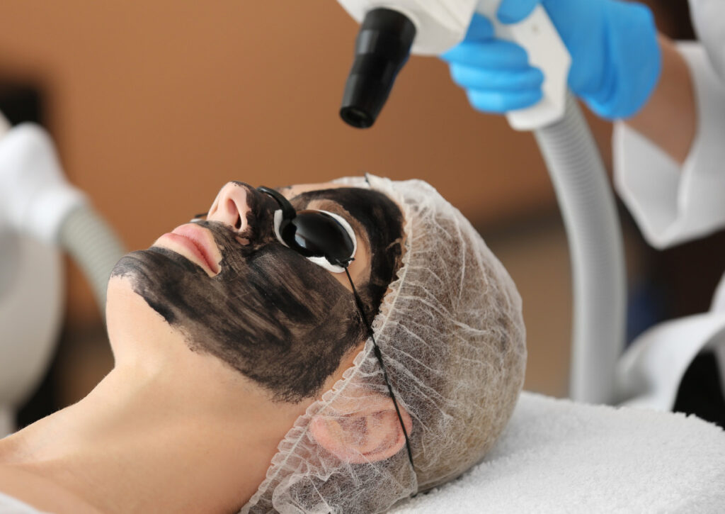 Carbon peel treatment at Dermadent Clinic