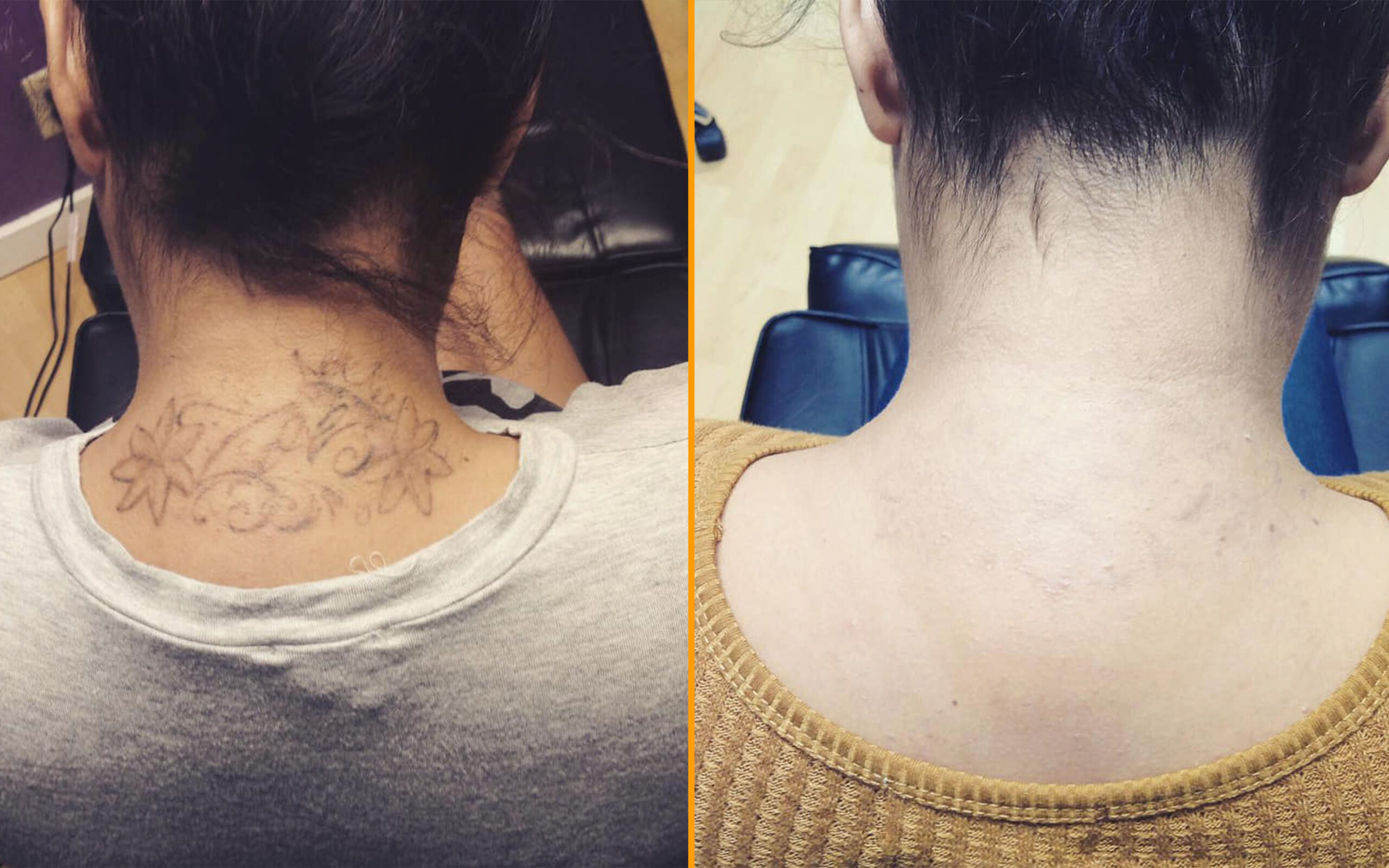 Tattoo removal treatment reference