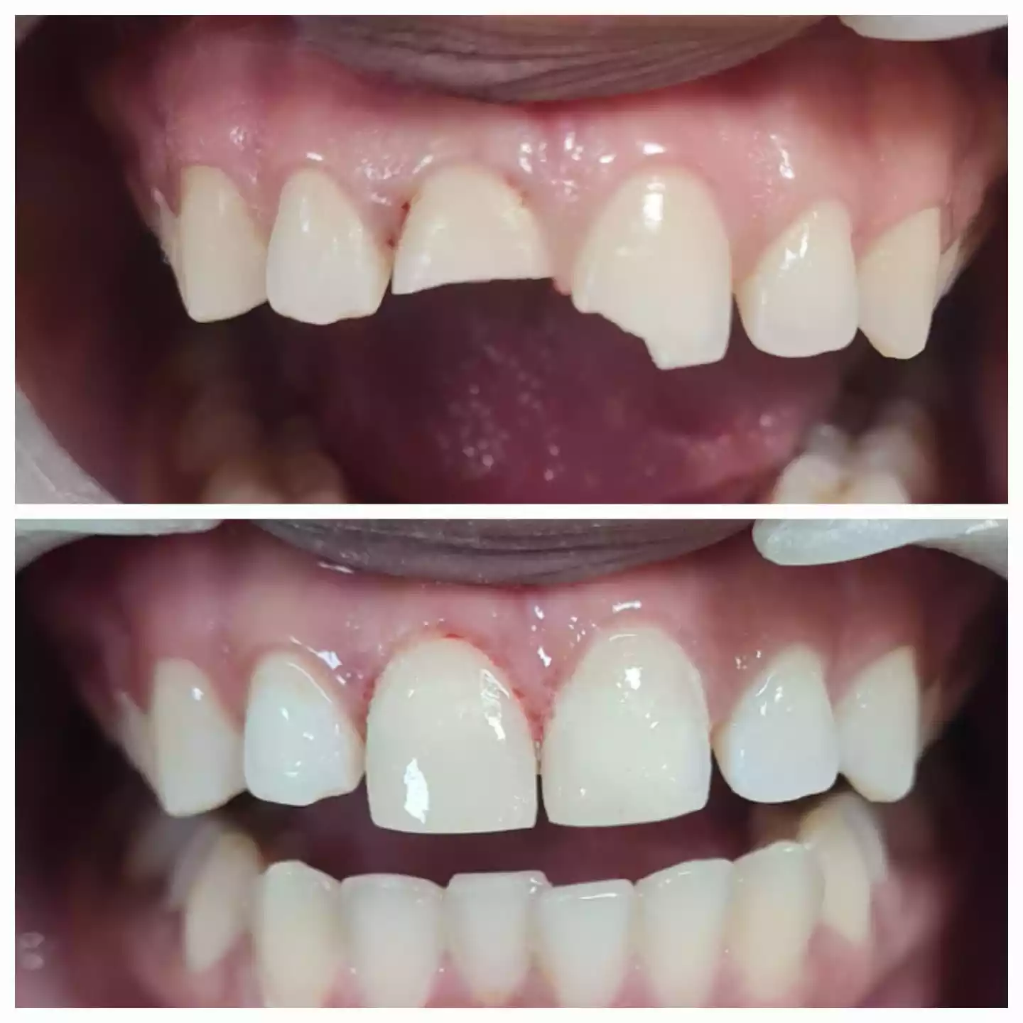 Dental fracture repair case at Dermadent Clinic