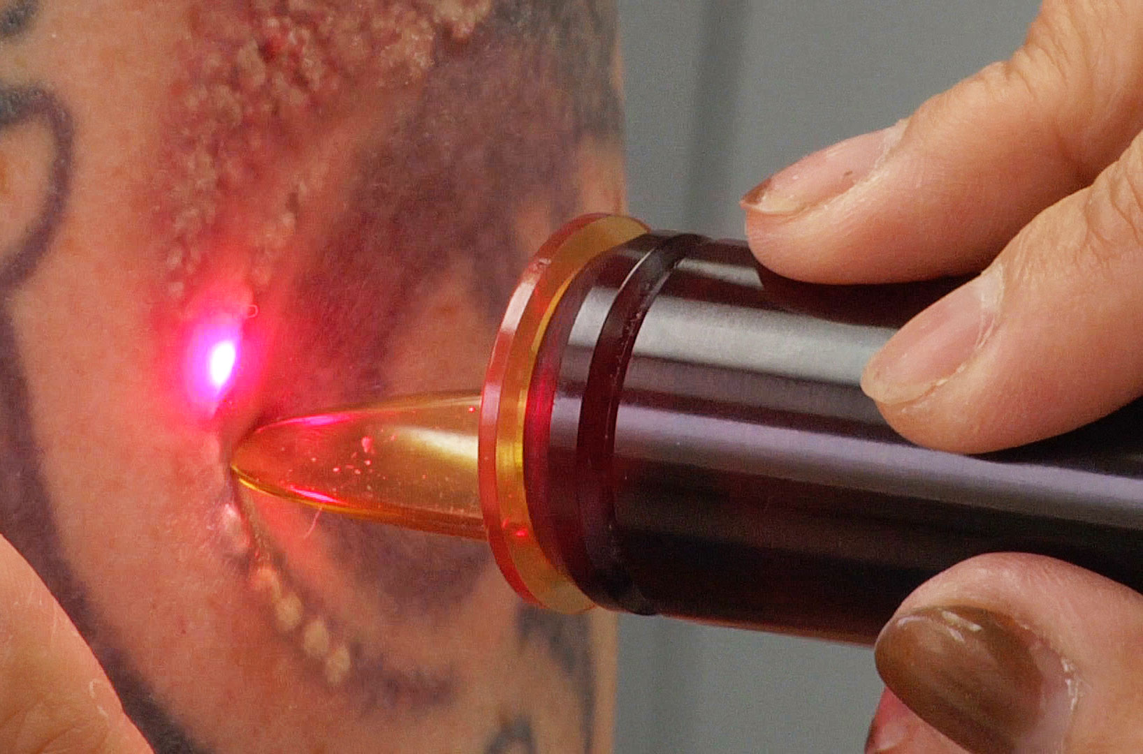 Laser tattoo removal treatment close-up