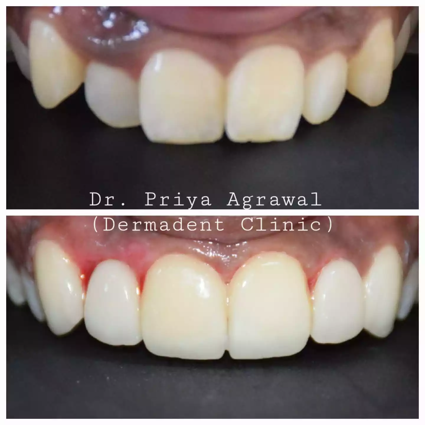Dental veneers case at Dermadent Clinic