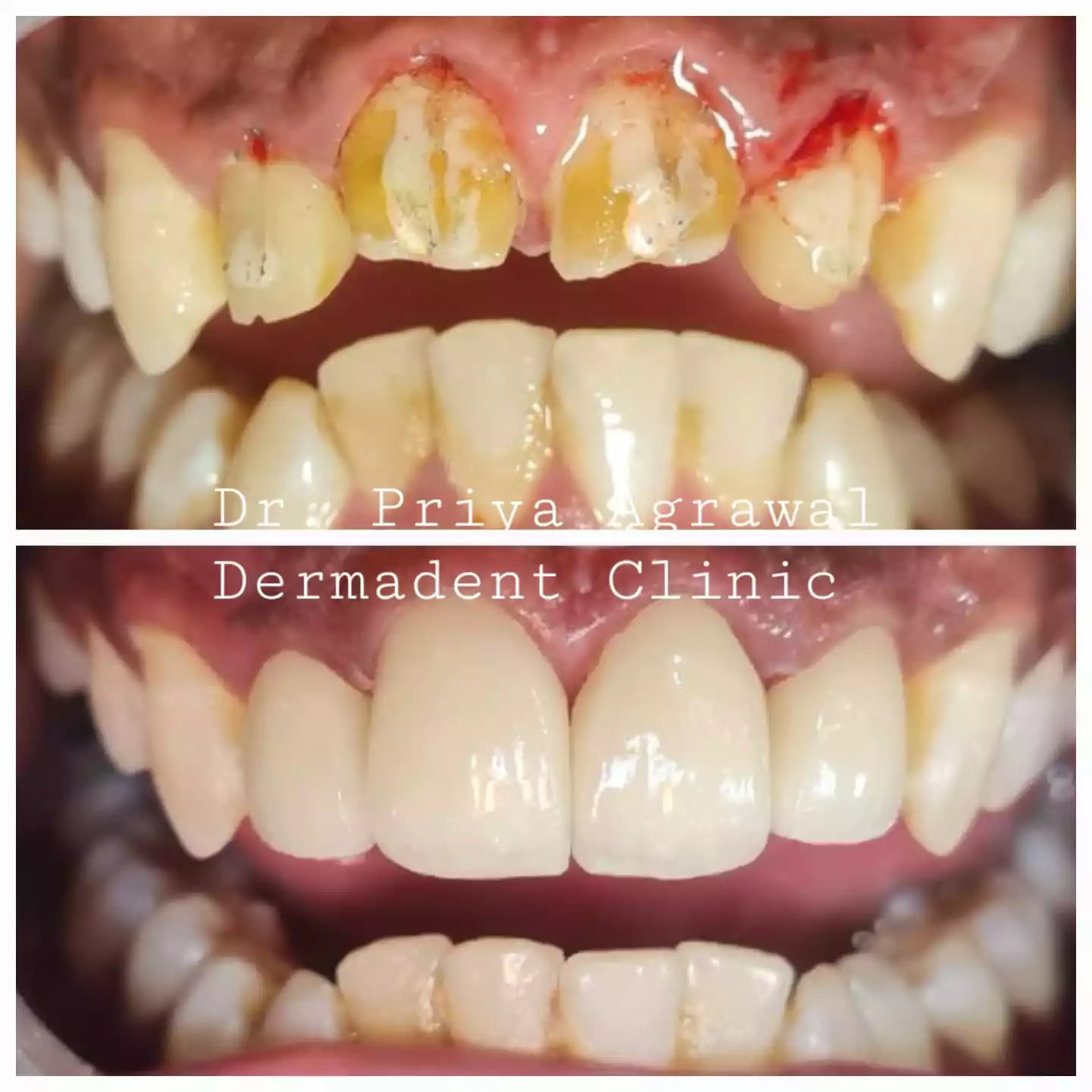 Zirconia crowns case at Dermadent Clinic