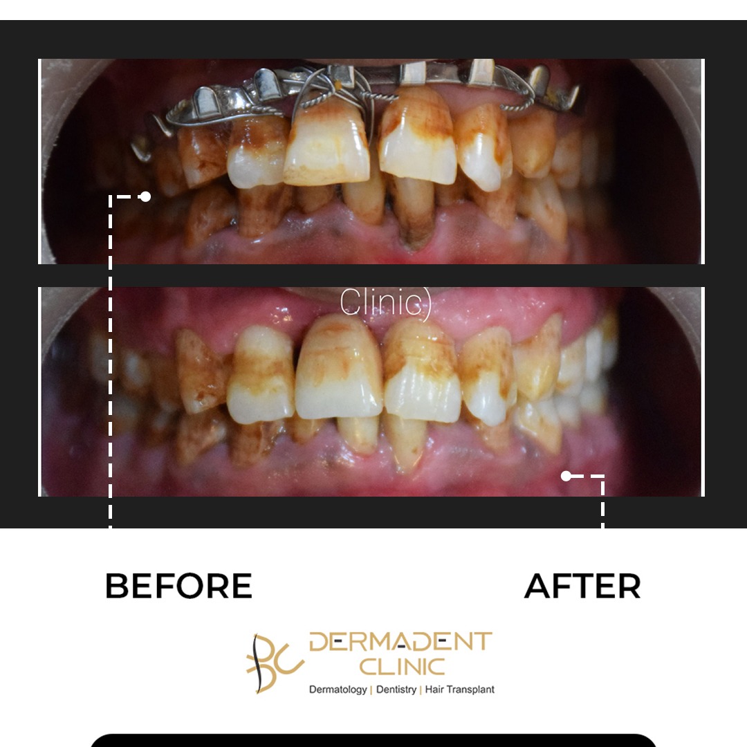 Dental patient result at Dermadent Clinic