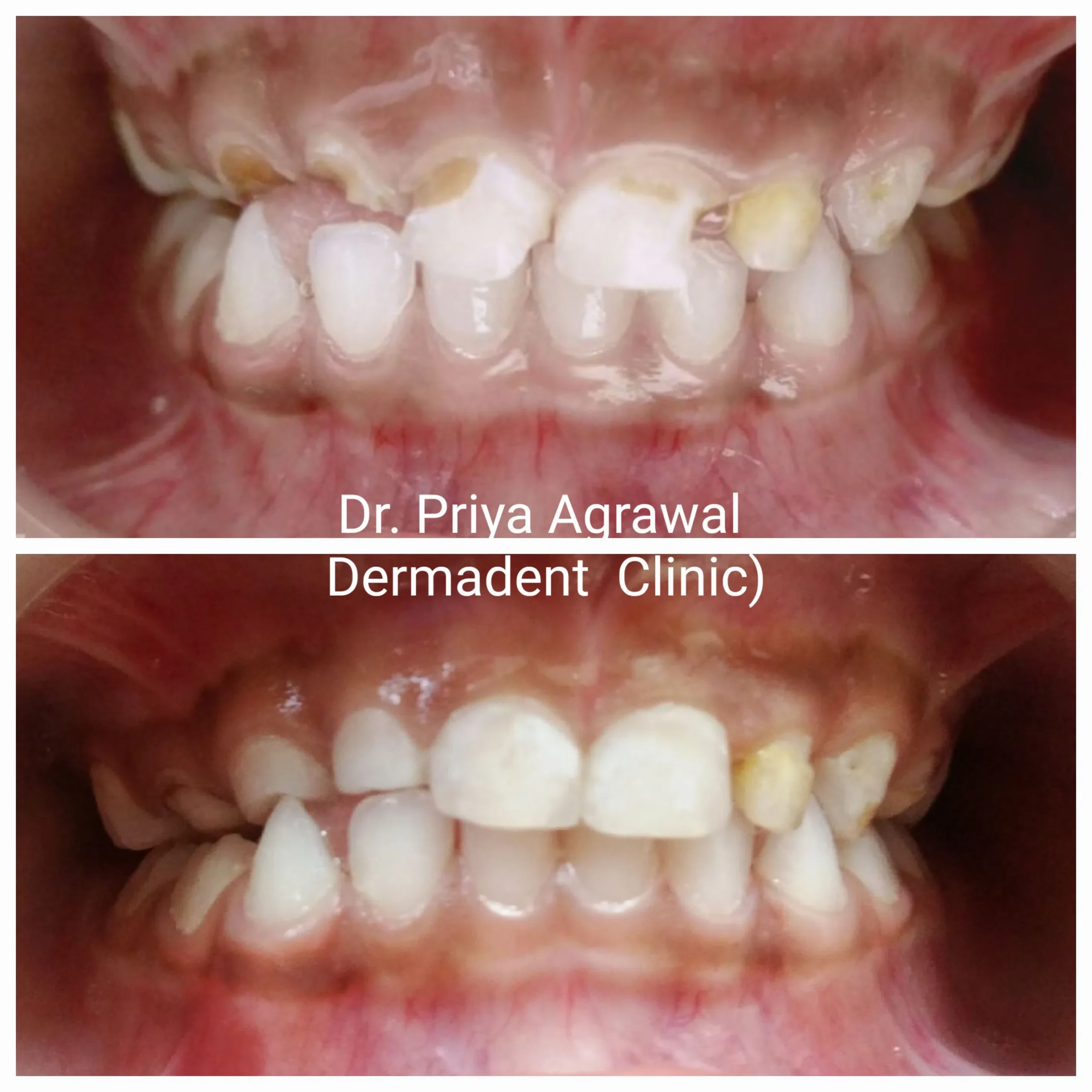 dermadent-udaipur-dental-caries-treatment-in-children