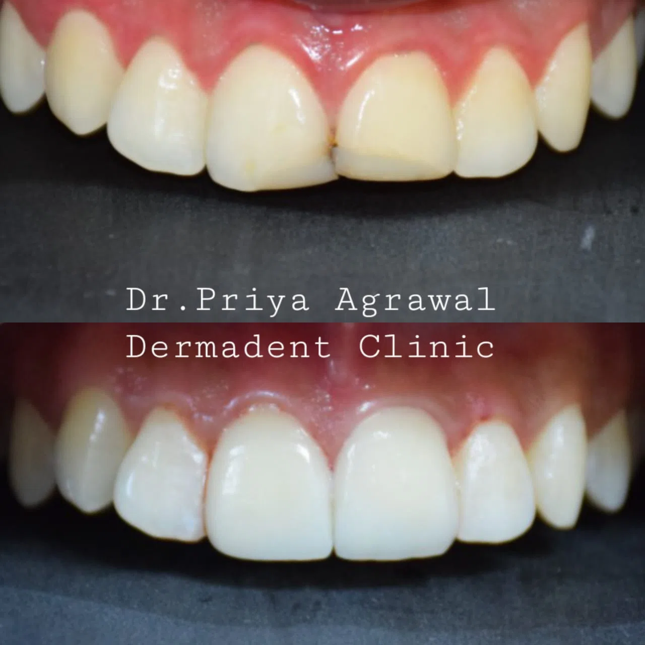 dermadent-udaipur-dental-ceramic-veneers