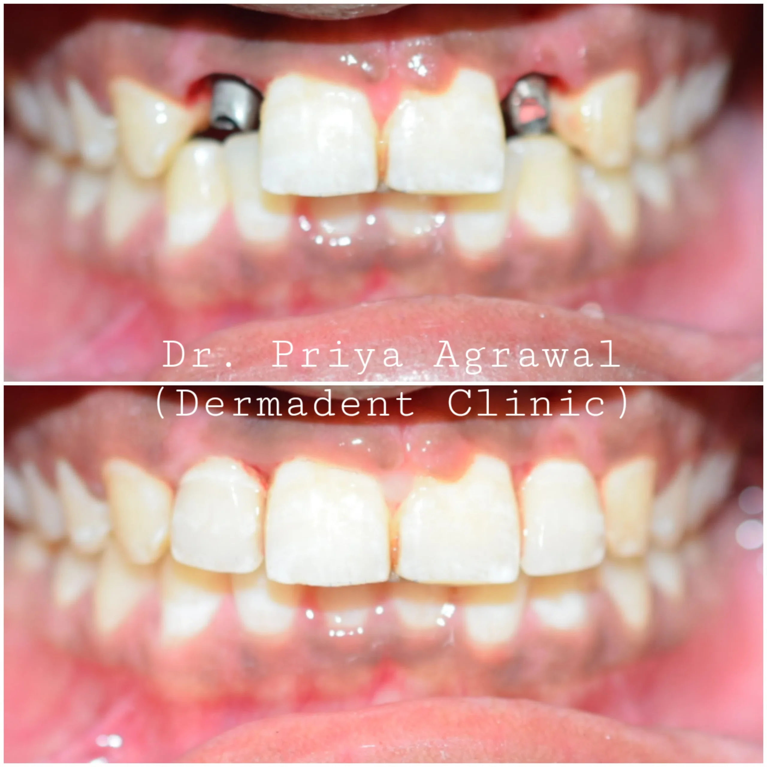 dermadent-udaipur-dental-dental-implants-2