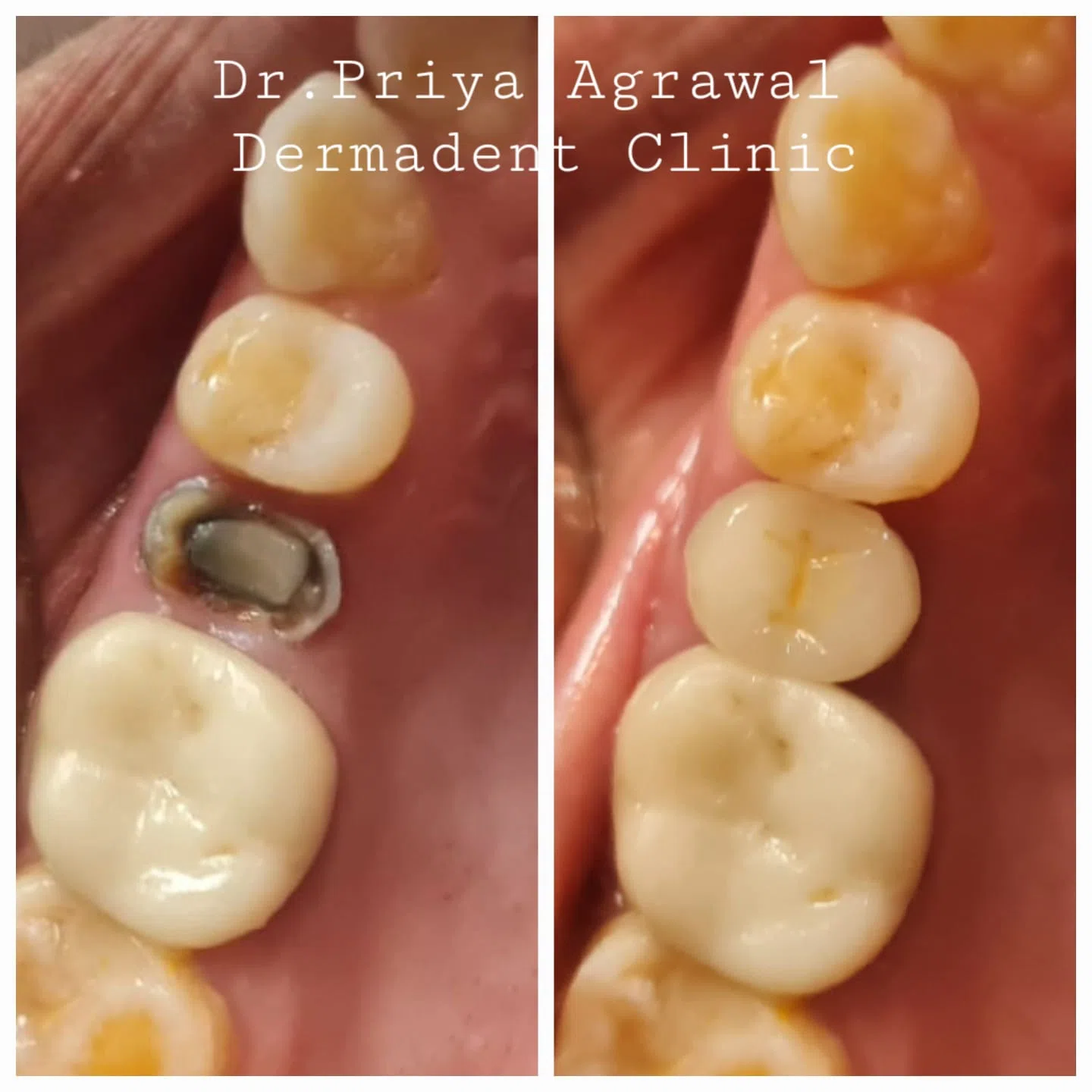 dermadent-udaipur-dental-endo-crown