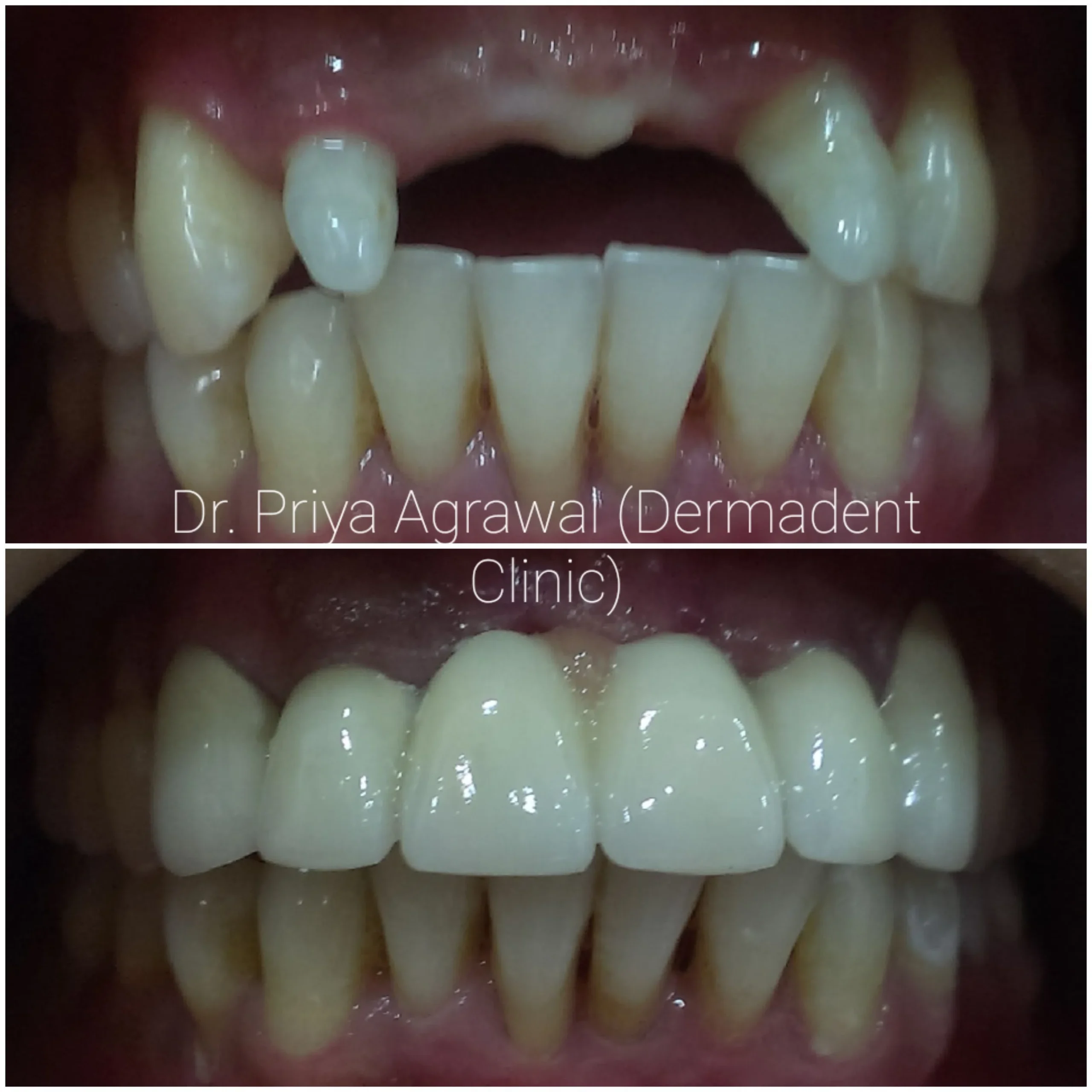 dermadent-udaipur-dental-fixed-partial-denture