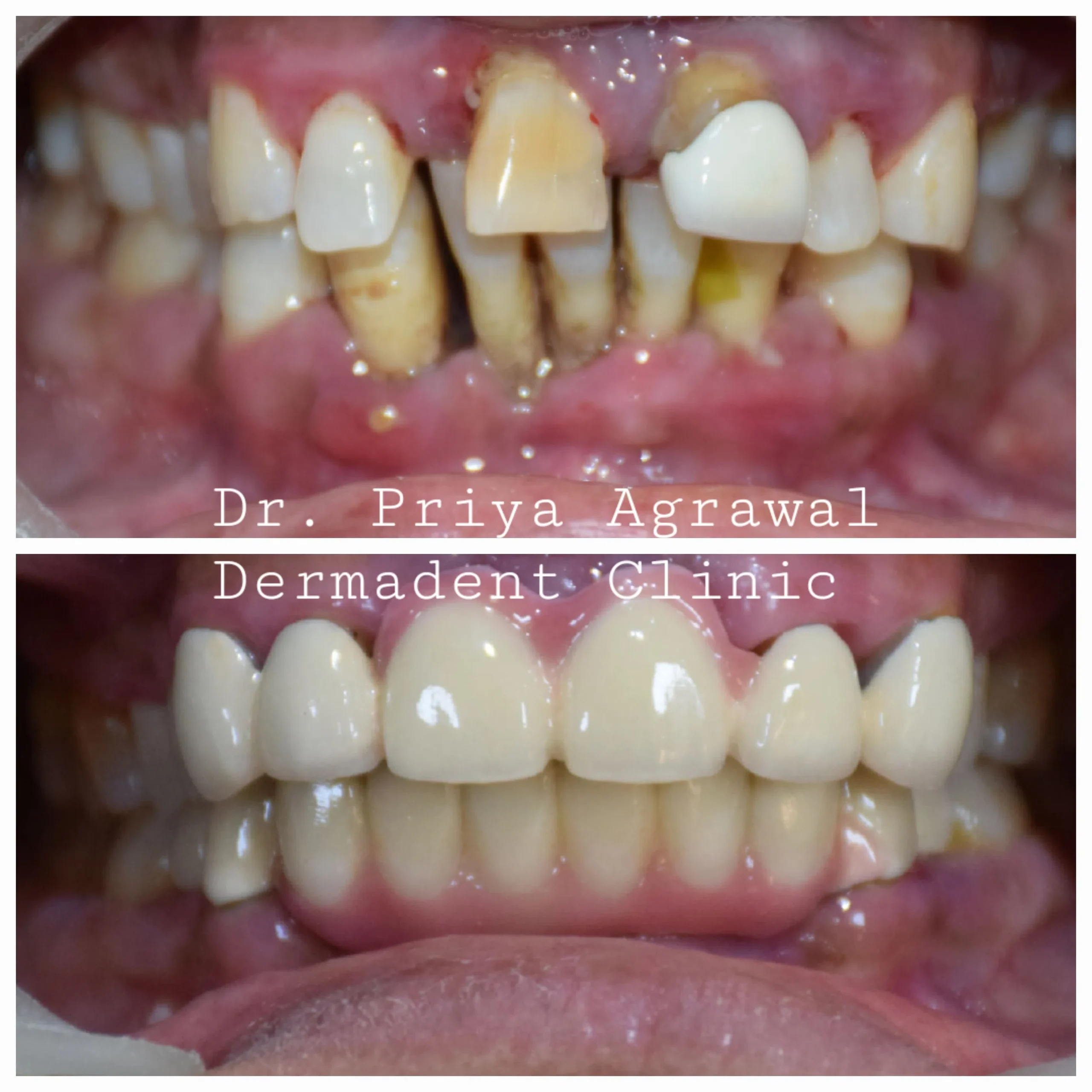 dermadent-udaipur-dental-fixed-teeth-replacement