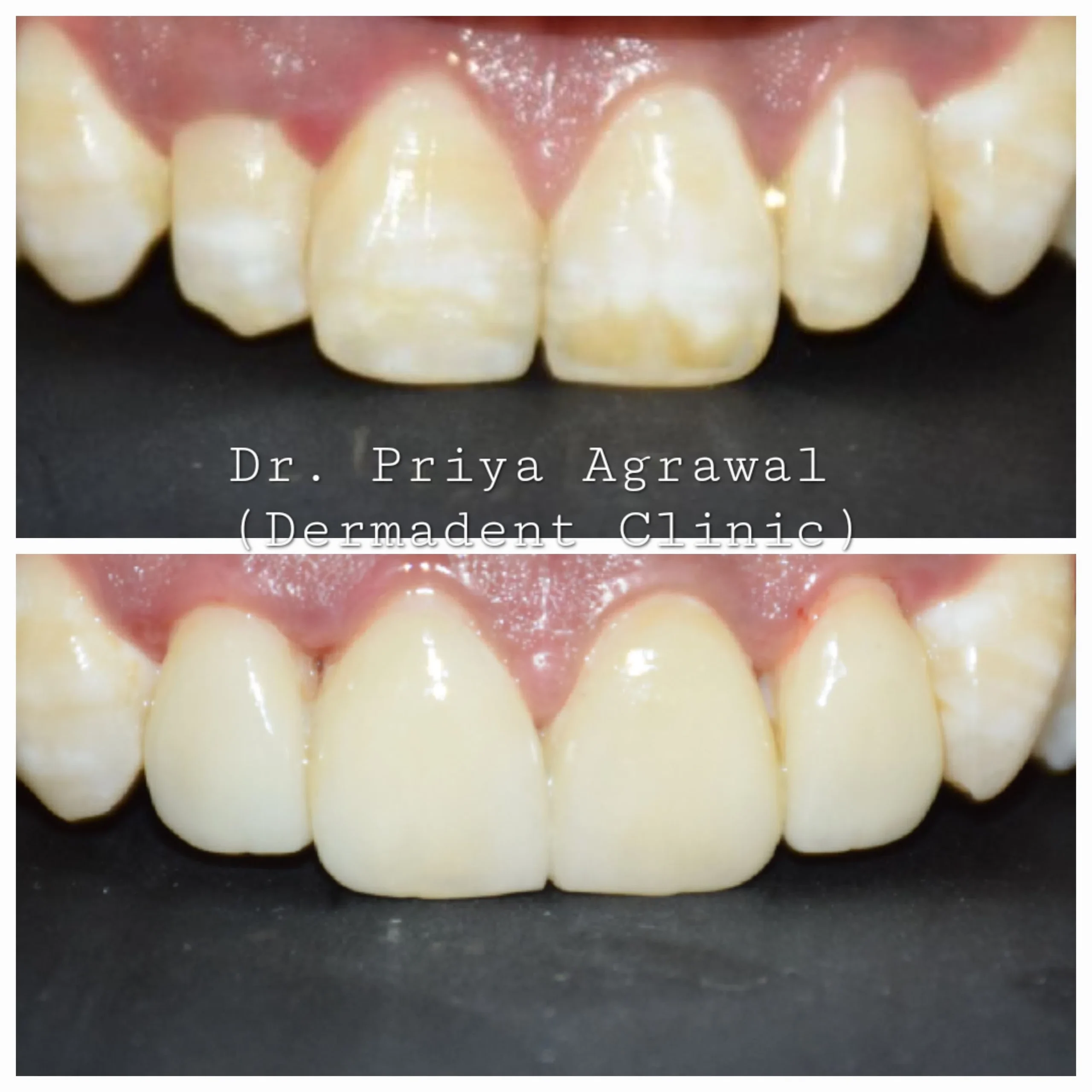 dermadent-udaipur-dental-flourosis-management
