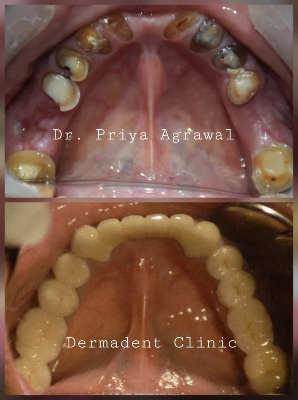 dermadent-udaipur-dental-fmr-lower-jaw