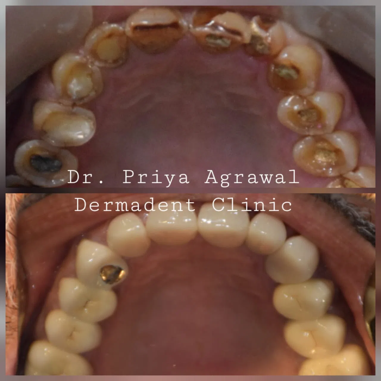 dermadent-udaipur-dental-fmr-upper-jaw