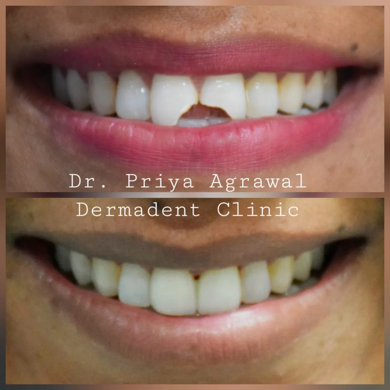 dermadent-udaipur-dental-fracture-management