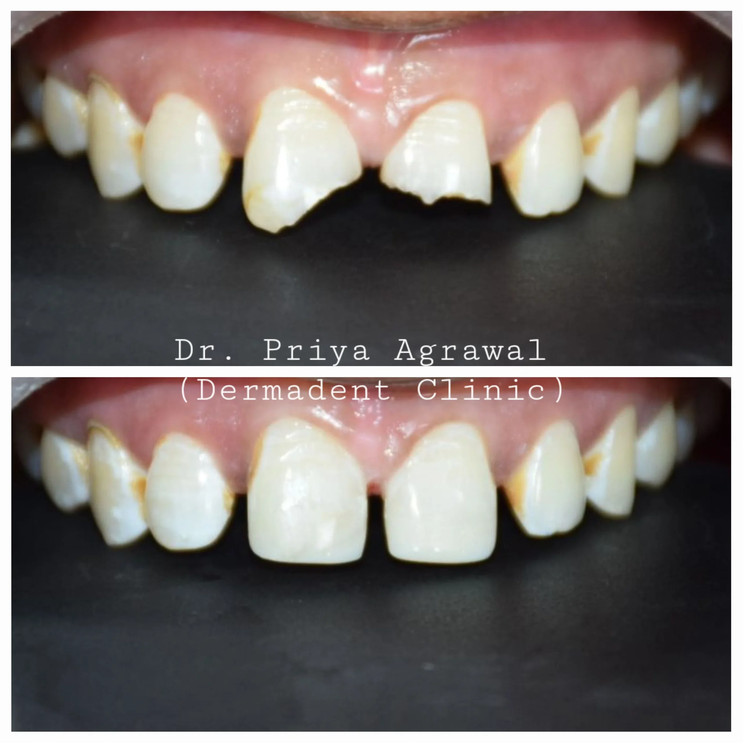 dermadent-udaipur-dental-fracture-repair-2