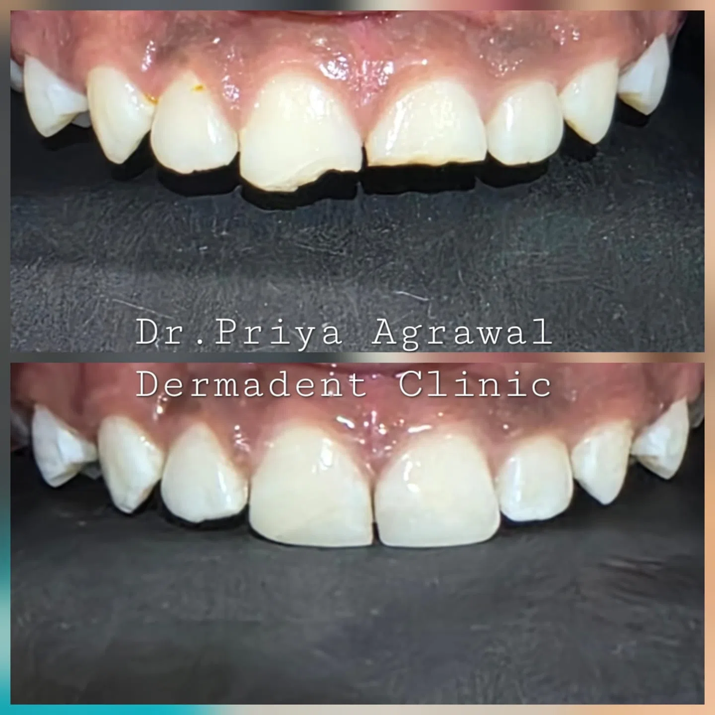 dermadent-udaipur-dental-fracture-repair