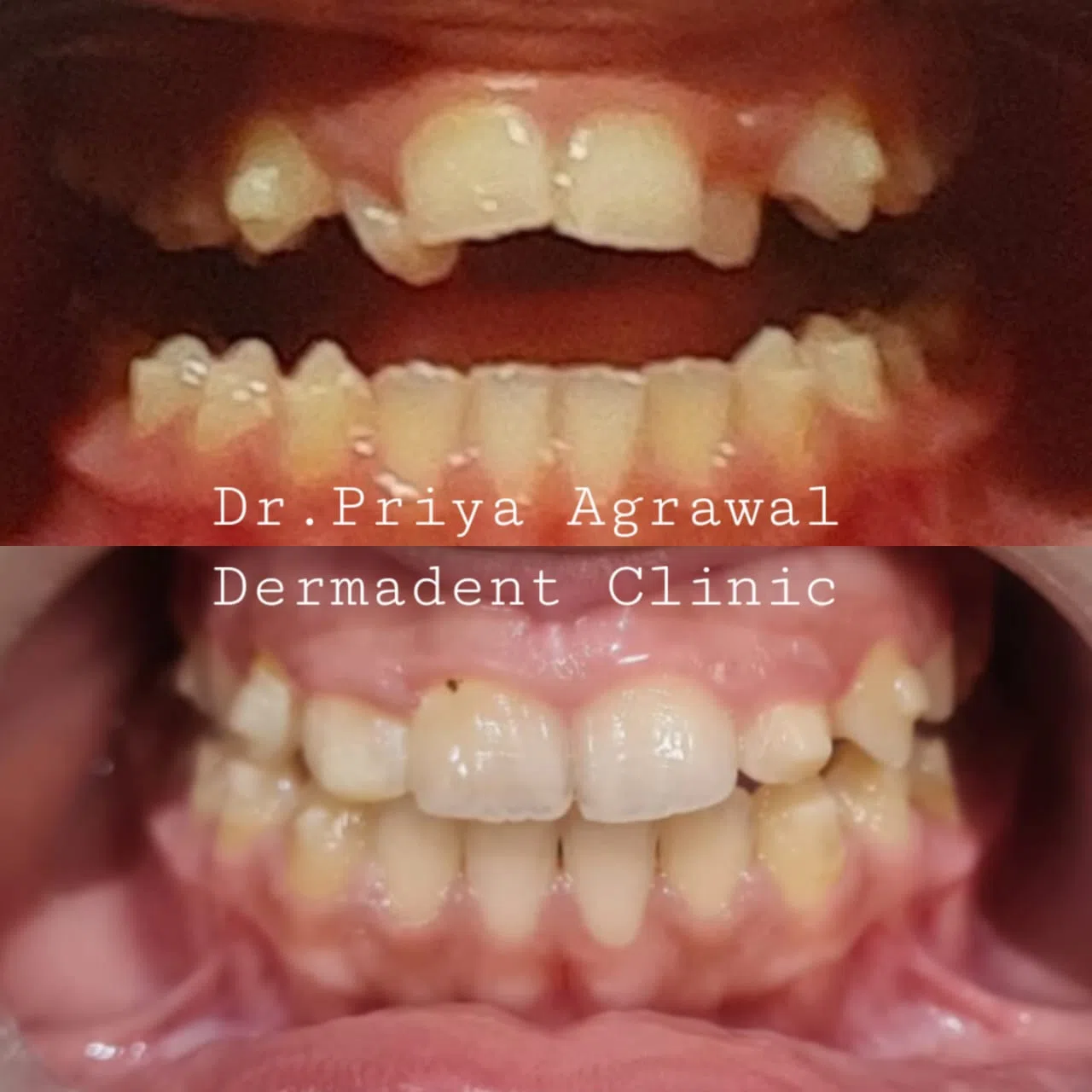 dermadent-udaipur-dental-invisalign