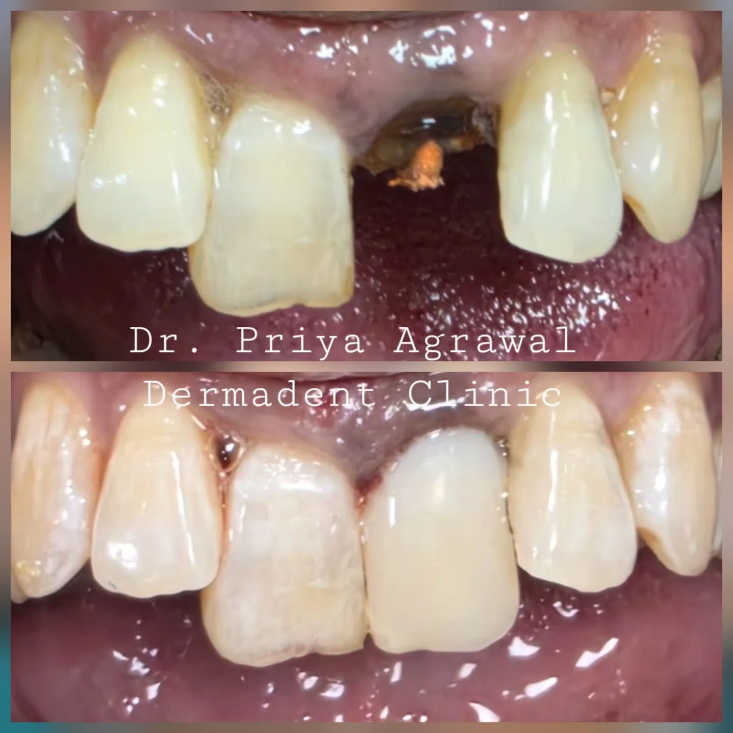 dermadent-udaipur-dental-tooth-build-up