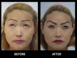 dermadent-udaipur-skin-botox-fillers-slide1