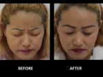 dermadent-udaipur-skin-botox-fillers-slide2