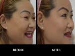 dermadent-udaipur-skin-botox-fillers-slide3