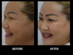 dermadent-udaipur-skin-botox-fillers-slide4