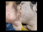 dermadent-udaipur-skin-laser-hair-reduction-slide10