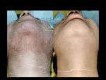 dermadent-udaipur-skin-laser-hair-reduction-slide11