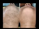 dermadent-udaipur-skin-laser-hair-reduction-slide12
