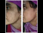 dermadent-udaipur-skin-laser-hair-reduction-slide13