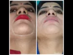 dermadent-udaipur-skin-laser-hair-reduction-slide14