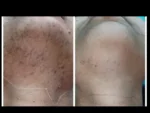 dermadent-udaipur-skin-laser-hair-reduction-slide15