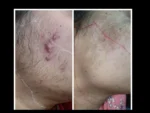 dermadent-udaipur-skin-laser-hair-reduction-slide16