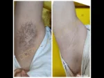 dermadent-udaipur-skin-laser-hair-reduction-slide2