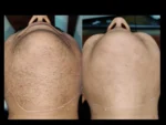 dermadent-udaipur-skin-laser-hair-reduction-slide3