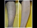 dermadent-udaipur-skin-laser-hair-reduction-slide4