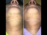 dermadent-udaipur-skin-laser-hair-reduction-slide5