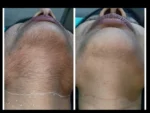 dermadent-udaipur-skin-laser-hair-reduction-slide6