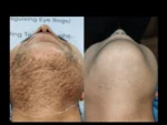 dermadent-udaipur-skin-laser-hair-reduction-slide7