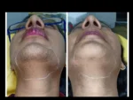 dermadent-udaipur-skin-laser-hair-reduction-slide8