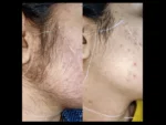 dermadent-udaipur-skin-laser-hair-reduction-slide9
