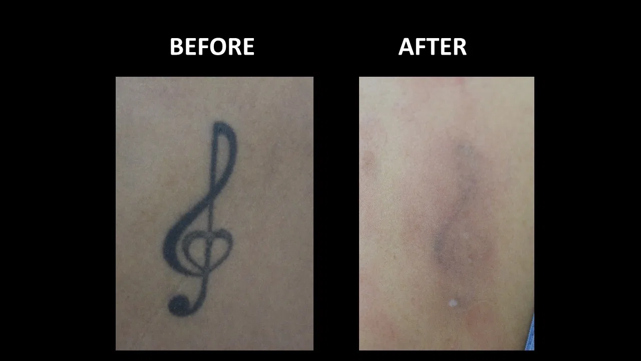 Tattoo fading result after laser tattoo removal at Dermadent Clinic Udaipur