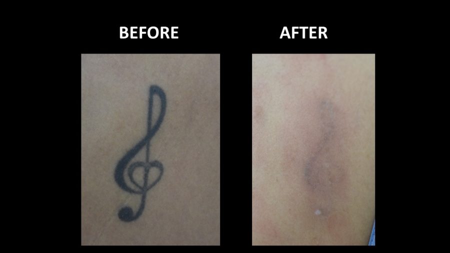 Tattoo removal before and after result at Dermadent Clinic Udaipur