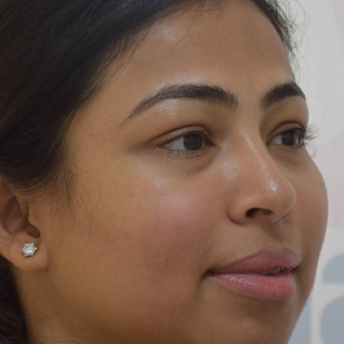 acne-treatment-before-after-dermadent-udaipur-01