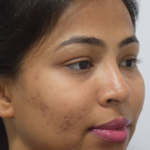 acne-treatment-before-after-dermadent-udaipur-02