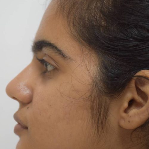 acne-treatment-before-after-dermadent-udaipur-03